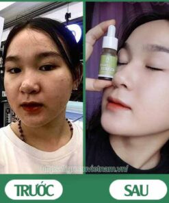 serum trị mụn diếp cá igreen