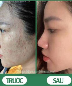 serum trị mụn diếp cá igreen