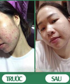 serum trị mụn diếp cá igreen