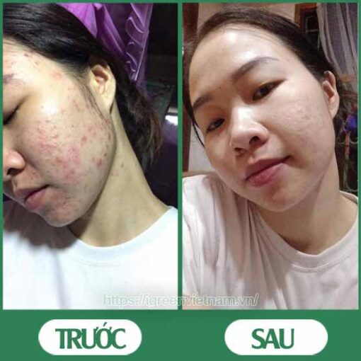 serum trị mụn diếp cá igreen