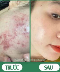 serum trị mụn diếp cá igreen