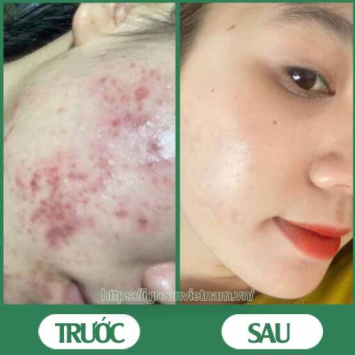 serum trị mụn diếp cá igreen