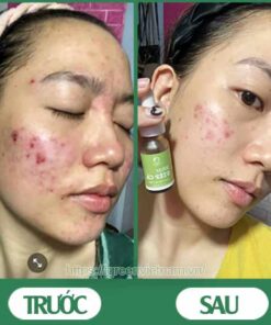 serum trị mụn diếp cá igreen