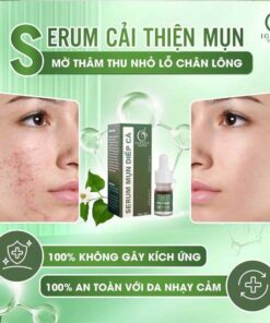 serum trị mụn diếp cá igreen - giải pháp tự nhiên cho làn da sáng khỏe, không tì vết